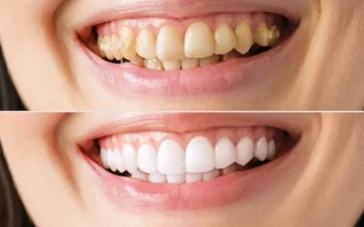 Sonrisa, ¿Linda o Espantosa?